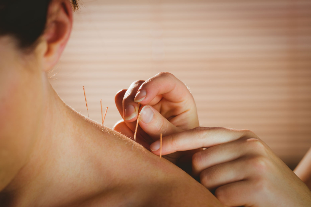 Professional acupuncture treatment